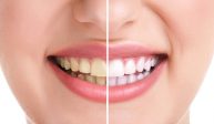 Benefits of teeth whitening